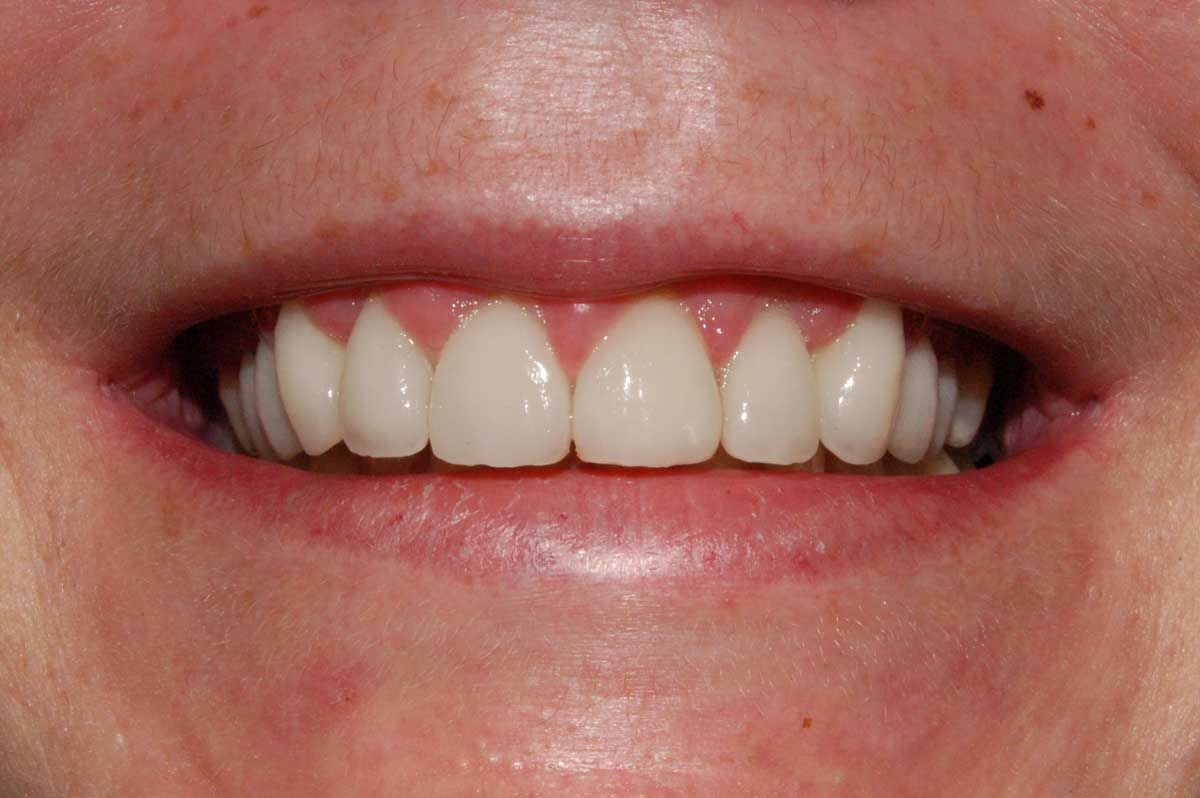dental veneers after treatment
