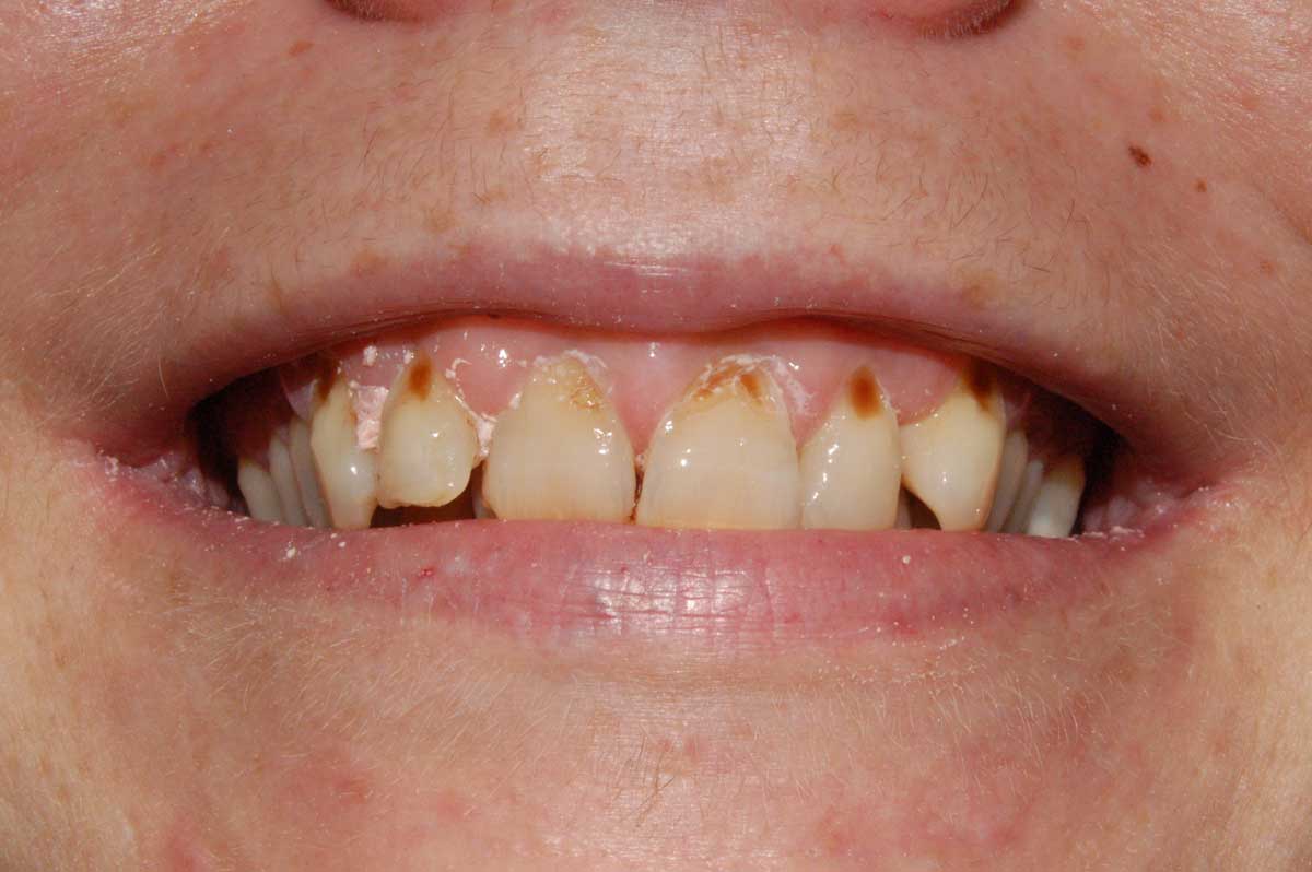 dental veneers before treatment