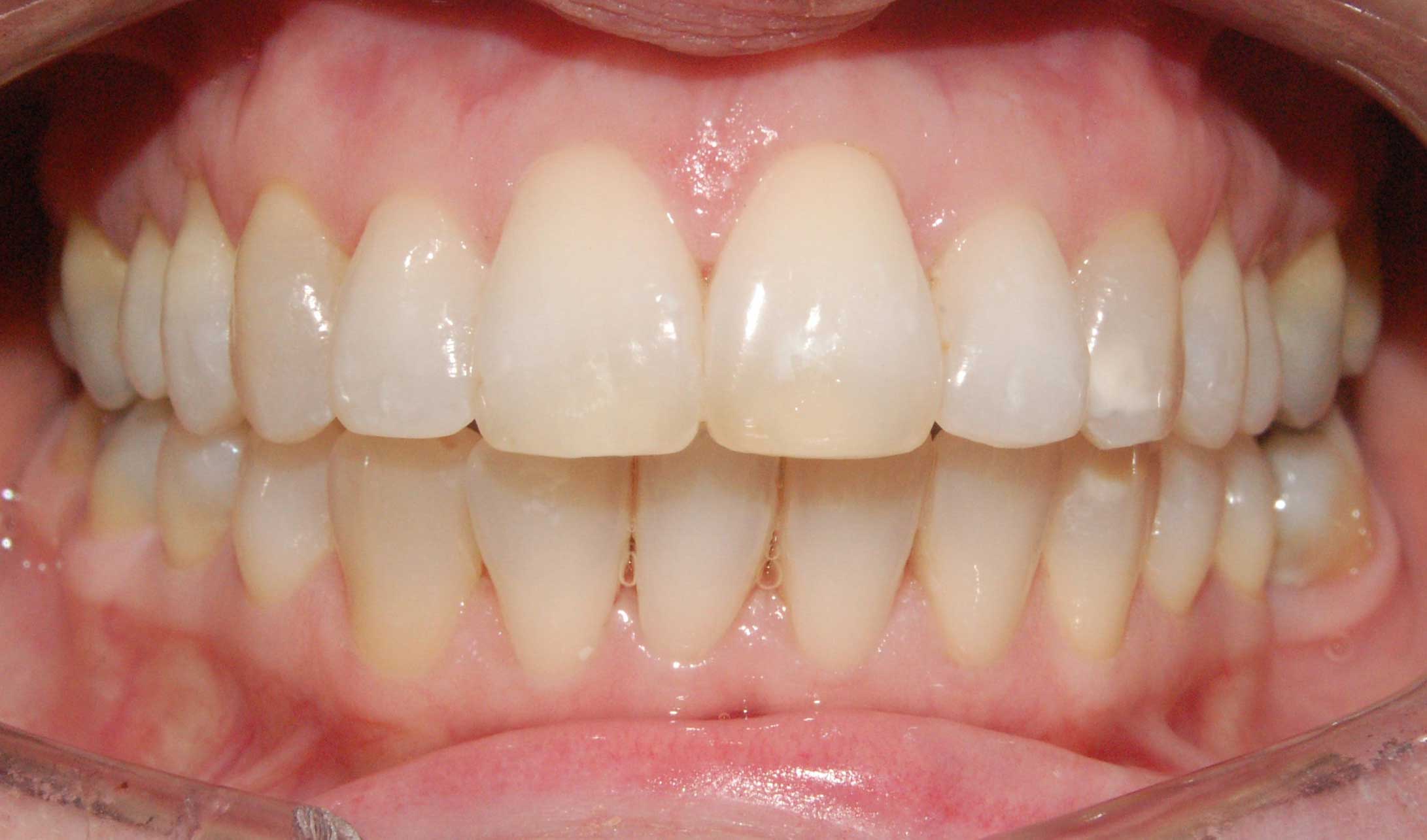 invisalign after treatment