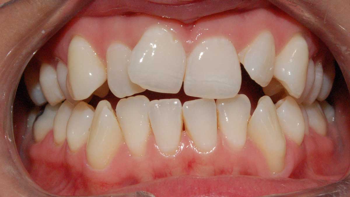 smile makeover before treatment