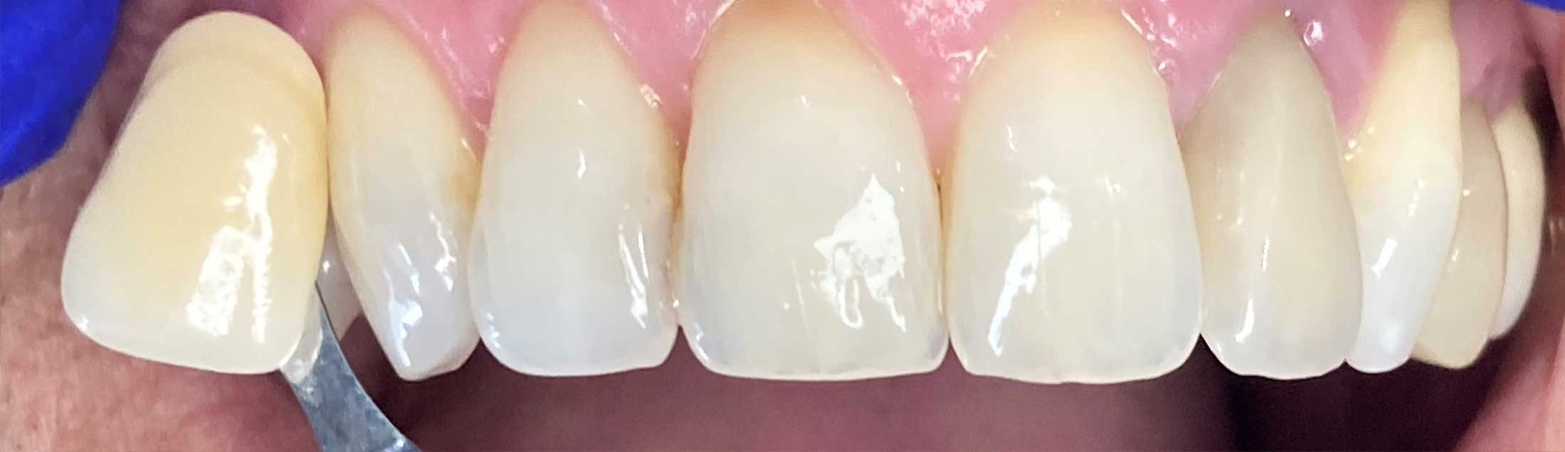 teeth whitening after treatment
