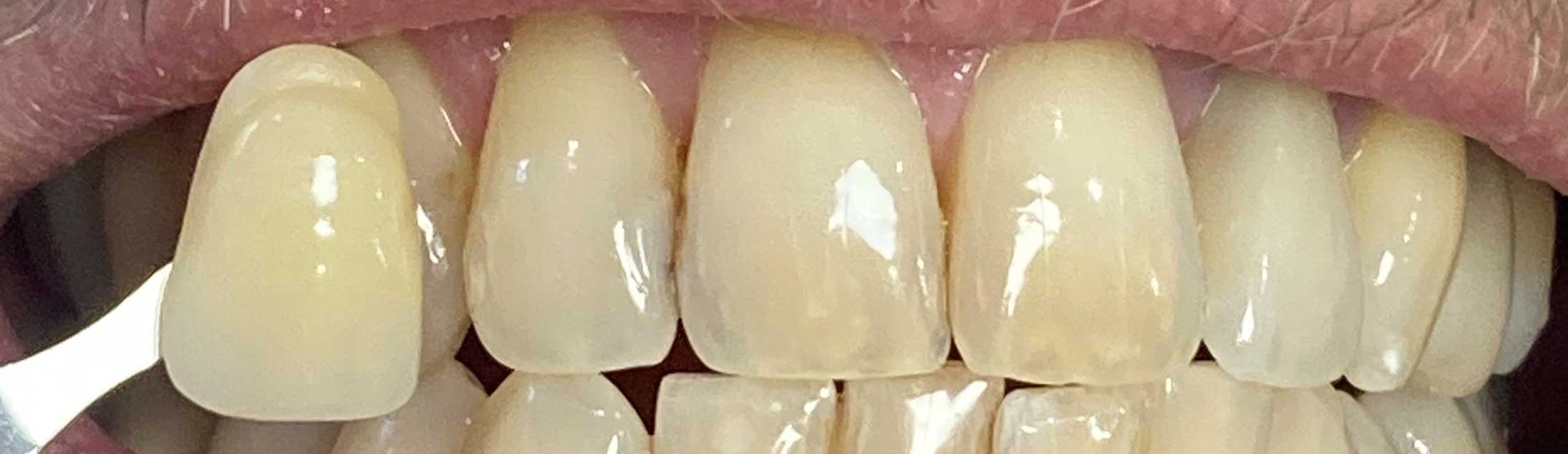 teeth whitening before treatment