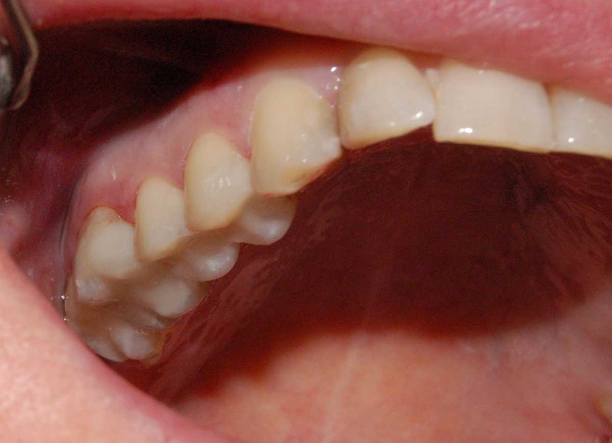 white fillings after treatment