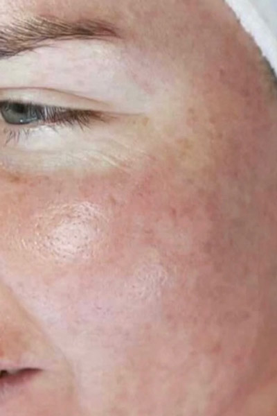 dermalux acne treatment after