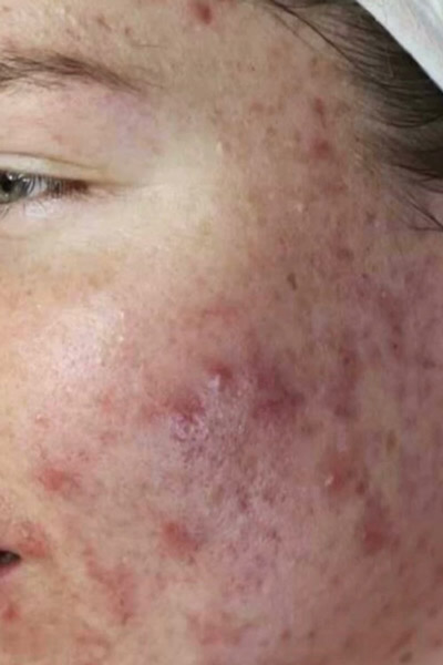 dermalux acne treatment before