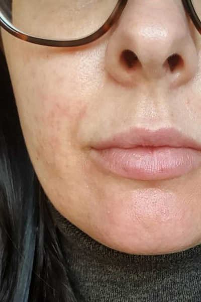 dermalux problematic skin treatment after