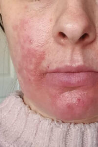 dermalux problematic skin treatment before