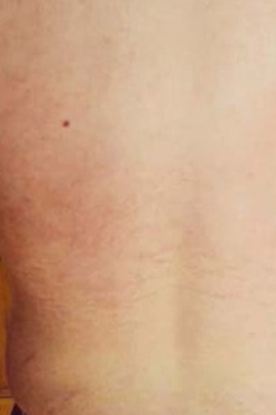 dermalux psoriasis treatment after