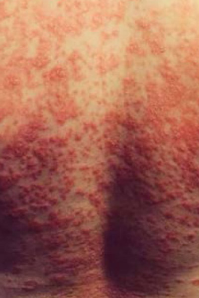 dermalux psoriasis treatment before