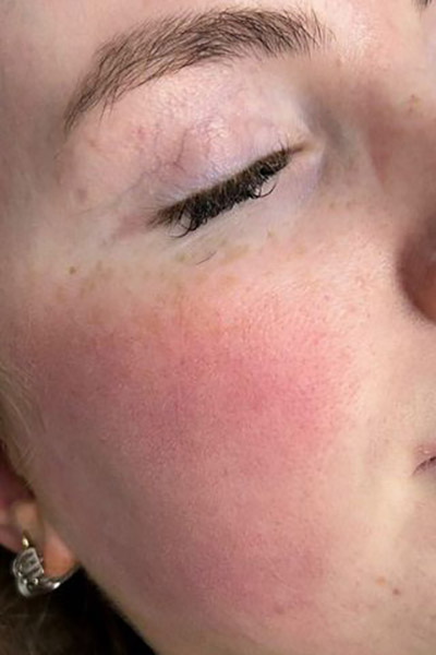 dermalux redness treatment before
